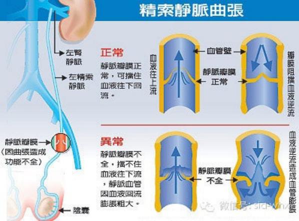 關(guān)于2021年征兵精索靜脈曲張標(biāo)準(zhǔn)的探討，2021年征兵精索靜脈曲張標(biāo)準(zhǔn)深度解析