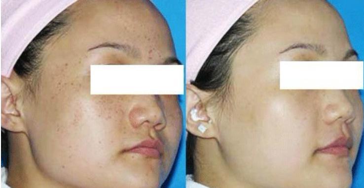 激光祛斑后需要注意的五大事項(xiàng)，激光祛斑后的五大注意事項(xiàng)詳解