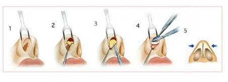 微調鼻子需要多少錢，全面解析費用因素與注意事項，微調鼻子費用全解析，費用因素與注意事項，需要多少錢？