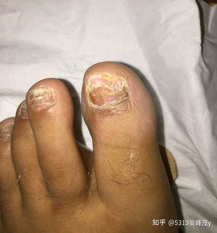 如何判斷自己是否得了灰指甲？，如何判斷自己是否得了灰指甲？詳細(xì)指南與解析。