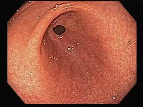 淺表性胃炎的癥狀及其影響，了解、預(yù)防與治療，淺表性胃炎的癥狀、影響、預(yù)防與治療全解析