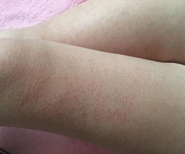 去除雞皮膚的小妙招，讓你的肌膚煥發(fā)自然光彩，雞皮膚改善秘訣，輕松告別不光滑，肌膚煥發(fā)自然光彩小妙招