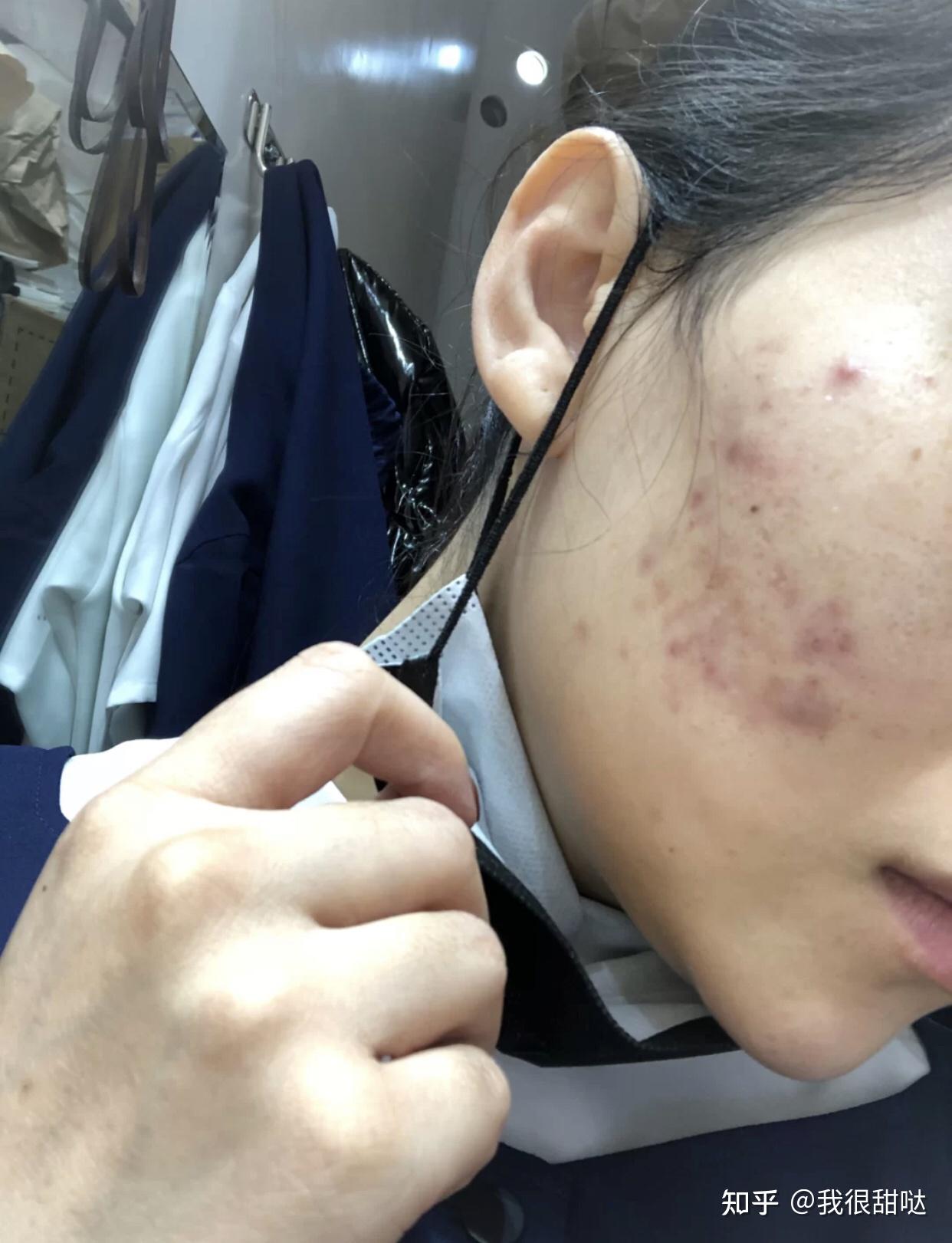 怎樣去除青春痘及痘印，全面解析有效方法，全面解析，青春痘與痘印的去除有效方法