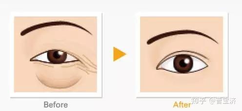 尋找最佳的眼袋治療醫(yī)院，專業(yè)解析與推薦，專業(yè)解析眼袋治療醫(yī)院推薦，助您尋找最佳治療機構(gòu)