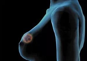 乳腺癌患者的生存期，了解與面對(duì)，乳腺癌患者的生存期，了解與面對(duì)的挑戰(zhàn)