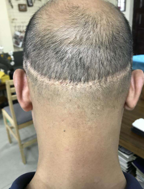 植發(fā)效果的持久性，能否長期維持與多種因素相關(guān)，植發(fā)效果的持久性與多種因素關(guān)聯(lián)，長期維持探討