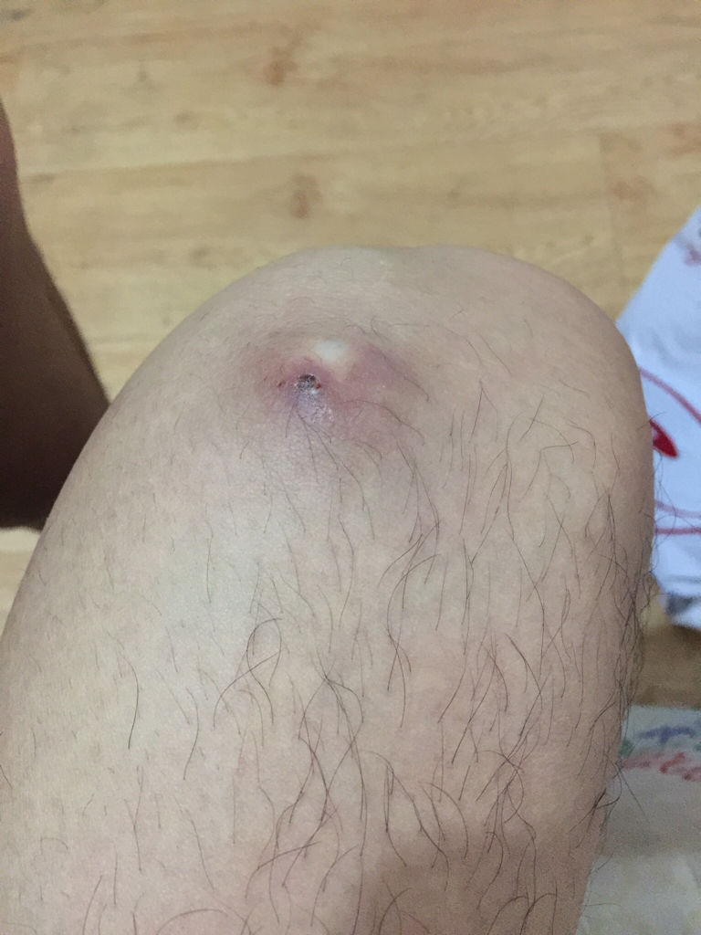 痘痘長不出來，肉里硬硬的，原因解析與應(yīng)對建議，痘痘無法冒出表面，內(nèi)部硬結(jié)成因解析及應(yīng)對之策