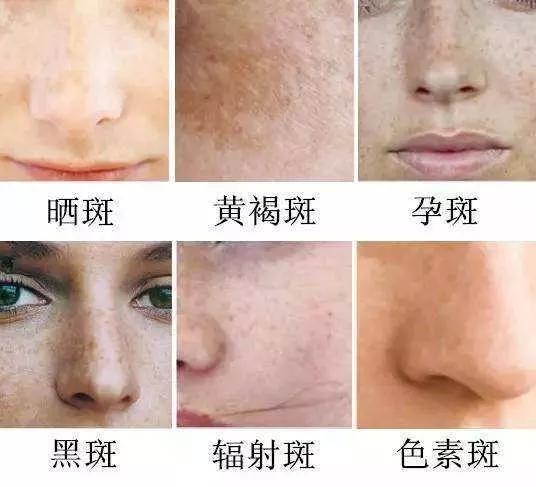 如何有效去除臉上斑點(diǎn)——全方位指南，全方位指南，如何有效去除臉上斑點(diǎn)