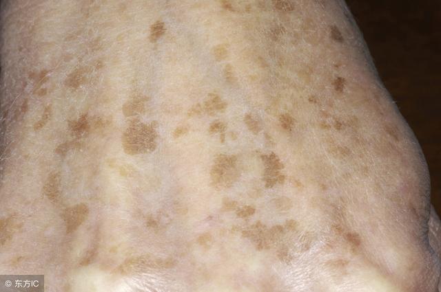 老年斑的形成原因及消除方法，老年斑的形成原因與消除方法全解析