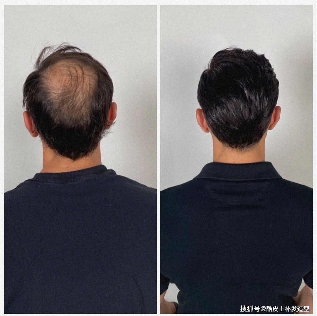 毛囊受損怎么恢復頭發(fā)，全面解析毛囊修復與頭發(fā)再生的方法，毛囊受損修復與頭發(fā)再生方法全面解析