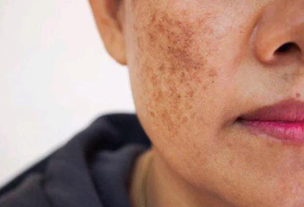 最簡(jiǎn)單除老年斑的偏方，最簡(jiǎn)單有效的老年斑去除偏方