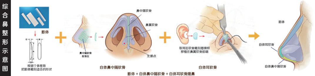 整鼻子手術(shù)費(fèi)用一般是多少，鼻子整形手術(shù)費(fèi)用詳解