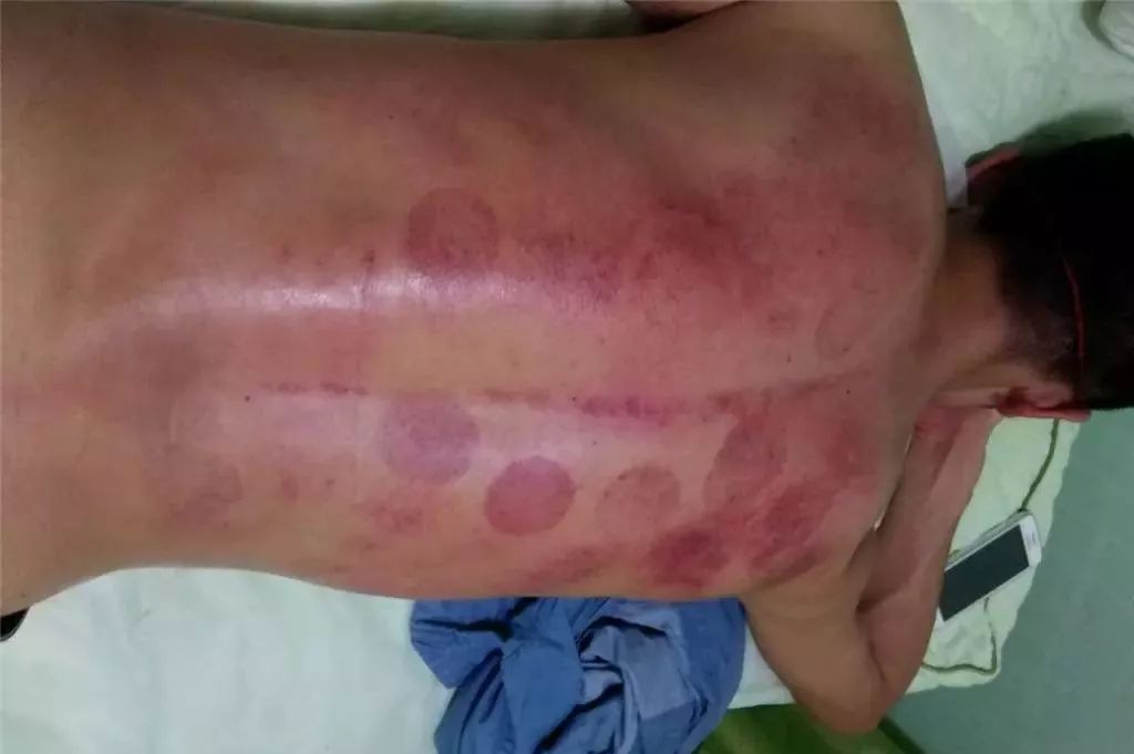 艾灸后如何判斷濕氣排出——一種直觀而實(shí)用的方法，艾灸后判斷濕氣排出的實(shí)用方法指南