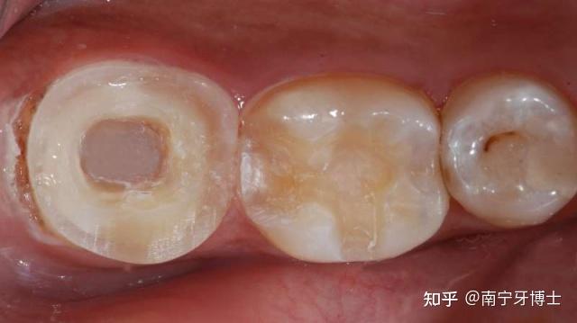 根管治療與牙冠選擇，深入了解，避免誤解，根管治療與牙冠選擇，全面解析，避免誤區(qū)