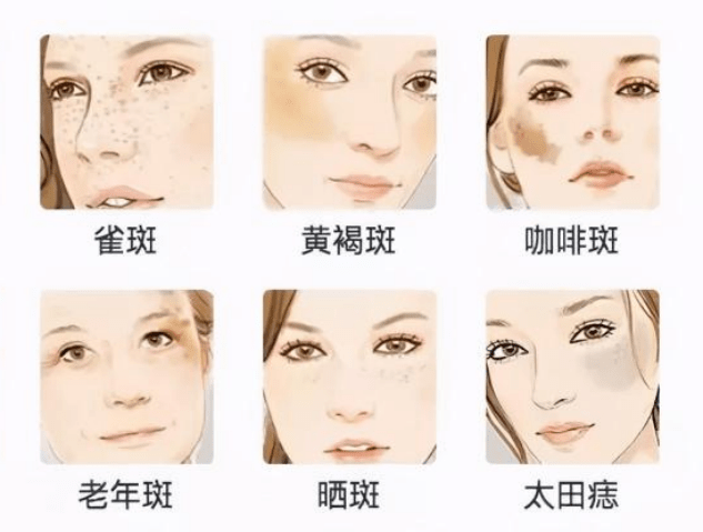 黃褐斑與曬斑的區(qū)別，深入了解兩種常見皮膚問題的差異，黃褐斑與曬斑的深入解析，兩種常見皮膚問題的差異探究