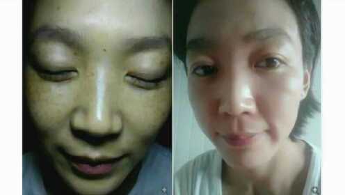 去掉黃褐斑的好方法，有效去除黃褐斑的方法