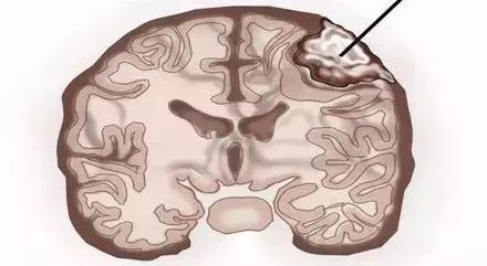 良性腫瘤的三大特征及其影響，良性腫瘤三大特征揭秘，生長、擴散與影響全解析