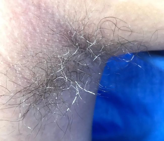 假性狐臭和狐臭的區(qū)別，假性狐臭與狐臭的差異解析