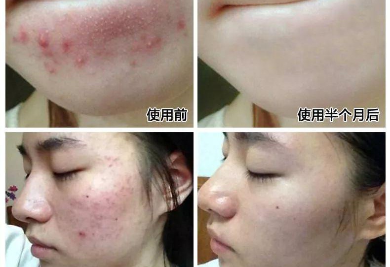 如何有效去除痘痘，全面解析最佳方法，全面解析，如何有效去除痘痘的最佳方法