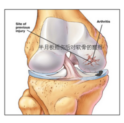 半月板最佳恢復(fù)方法，全方位指導(dǎo)與策略，全方位指導(dǎo)策略，半月板損傷的最佳恢復(fù)方法