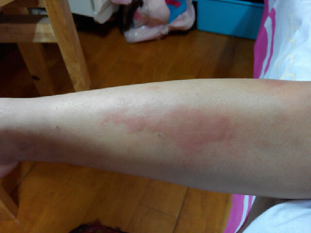 我用偏方成功治愈蕁麻疹，經(jīng)歷與分享，我用偏方成功治愈蕁麻疹，經(jīng)歷分享與治愈之路