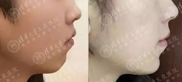 整容下頜骨大概需要多少錢——全面解析費(fèi)用因素與選擇策略，整容下頜骨費(fèi)用全面解析，費(fèi)用因素與選擇策略指南