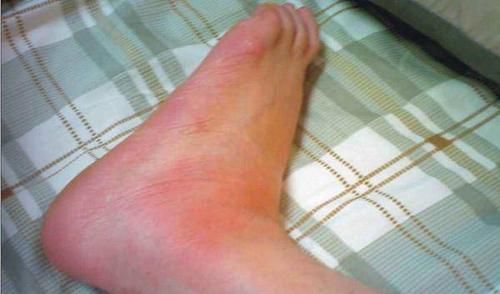 痛風(fēng)發(fā)作如何快速止痛消腫——痛風(fēng)患者的自救指南，痛風(fēng)發(fā)作快速止痛消腫自救指南