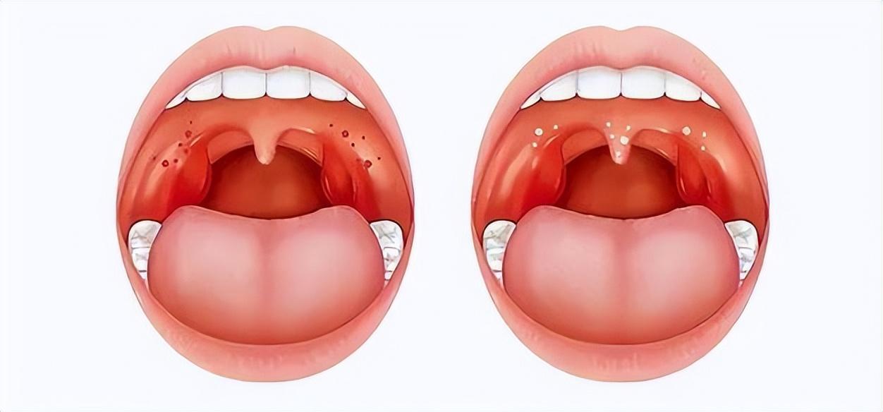 扁桃體腫大最好的治療方法，扁桃體腫大最佳治療方法探討
