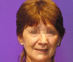 面癱的自我治療方法，面癱自我康復(fù)法，實(shí)用有效的自我治療方法