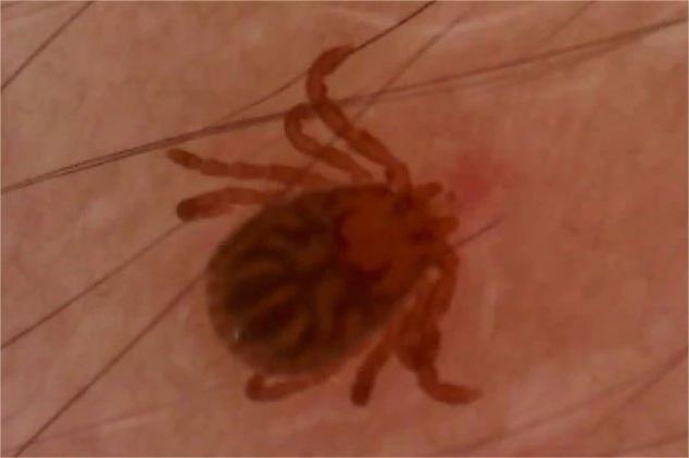 蜱蟲咬人后的癥狀及應(yīng)對措施，蜱蟲咬人后的癥狀與應(yīng)對措施解析