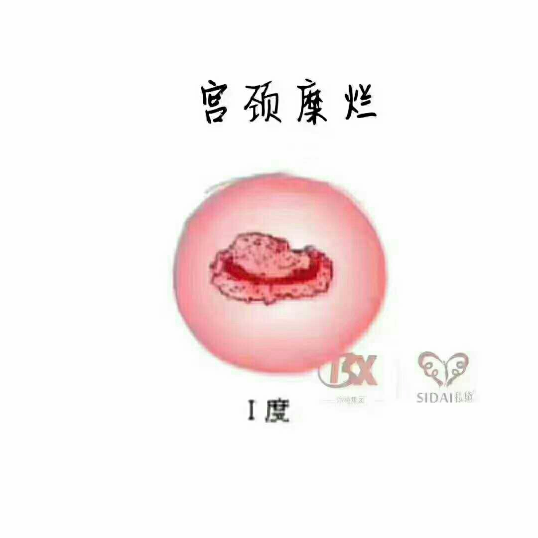 宮頸糜爛會自己恢復(fù)嗎？解讀宮頸健康與自我修復(fù)能力，宮頸糜爛的自我修復(fù)能力與宮頸健康解讀