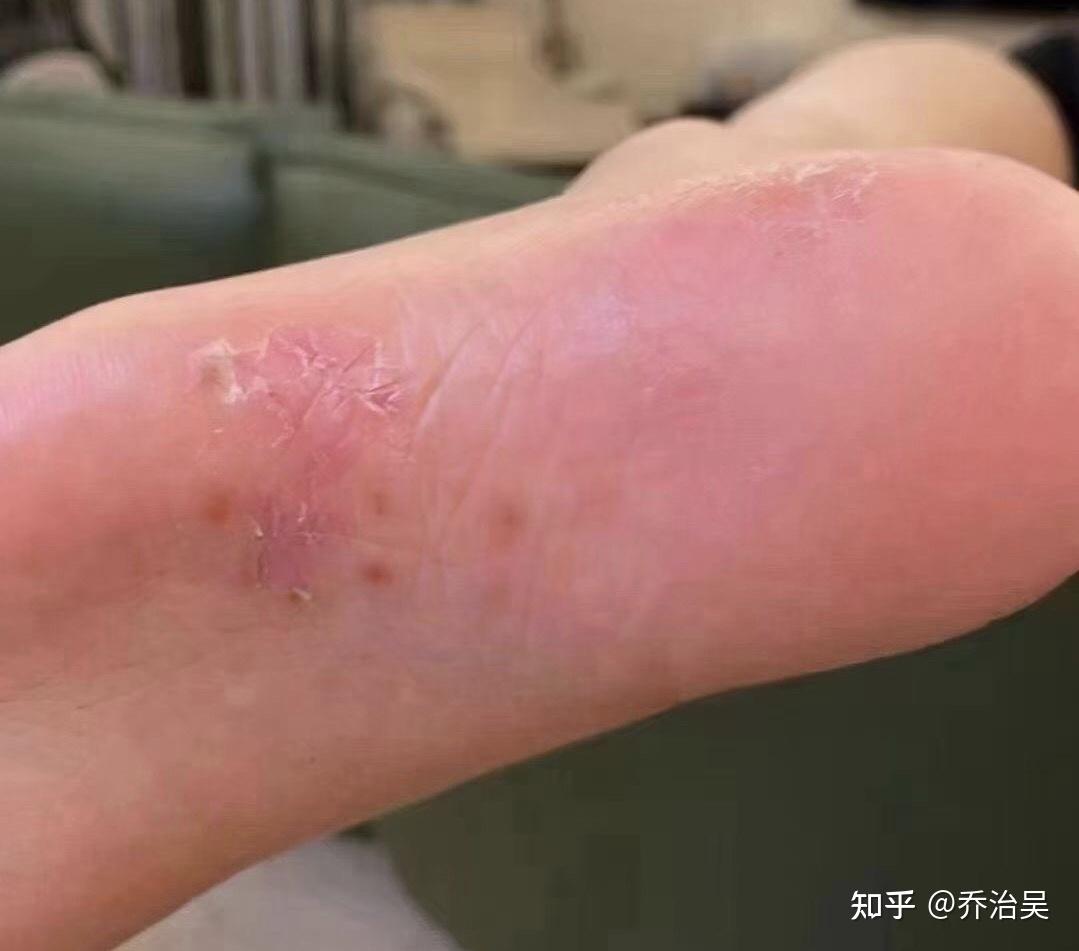 水泡型腳氣怎么根治，全面解析有效方法，全面解析，根治水泡型腳氣有效方法