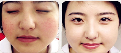 臉上紅血絲的治療方法，全面解析與應(yīng)對之道，全面解析與應(yīng)對之道，臉上紅血絲的治療方法