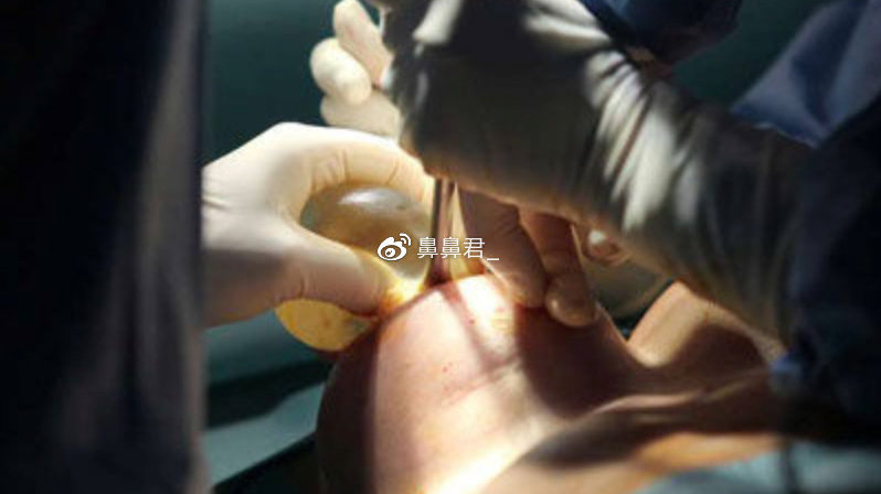 隆胸假體取出親身經(jīng)歷分享，我的手術(shù)經(jīng)歷與恢復(fù)過程，隆胸假體取出手術(shù)經(jīng)歷分享，我的恢復(fù)之旅