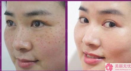 怎樣祛斑又快又有效，全面解析祛斑方法與技巧，全面解析，快速有效的祛斑方法與技巧