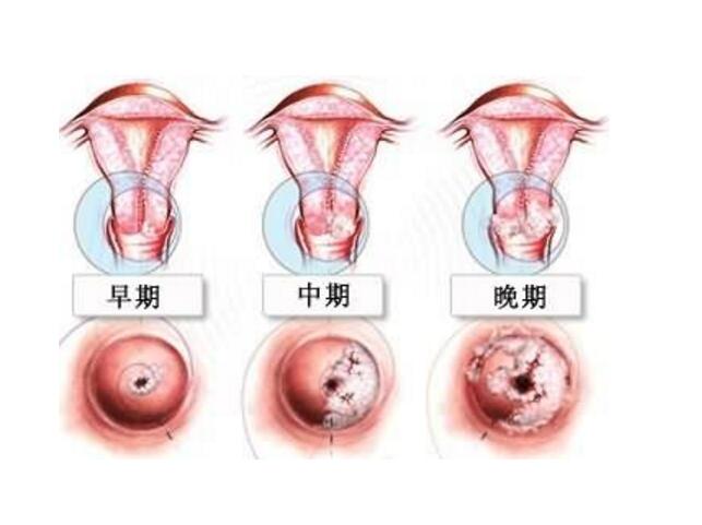 初期宮頸癌的征兆與應(yīng)對之策，初期宮頸癌的征兆及應(yīng)對策略
