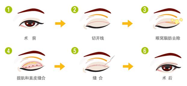 成都雙眼皮手術(shù)，尋找最優(yōu)秀的醫(yī)療機構(gòu)，成都雙眼皮手術(shù)最佳醫(yī)療機構(gòu)尋找指南