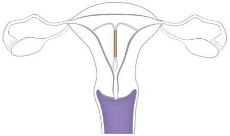 上環(huán)對身體有什么影響，全面解析與指導(dǎo)建議，全面解析與指導(dǎo)建議，上環(huán)對身體的影響及注意事項