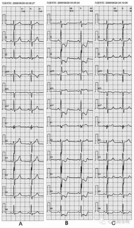 腦供血不足會自愈嗎？解析癥狀、原因及治療方法，腦供血不足詳解，癥狀、成因與治療方法，能否自愈？