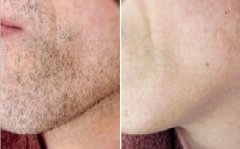 臉部脫毛需要多少錢，全面解析費用因素與選擇建議，臉部脫毛費用詳解，全面解析費用因素與選擇建議