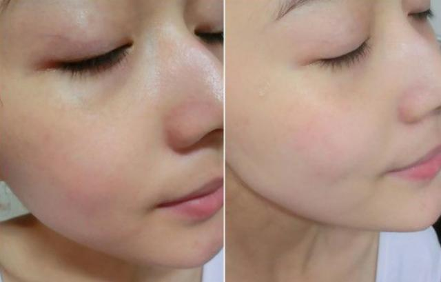 如何解決臉上出油太多的問題，解決臉部出油過多的方法技巧