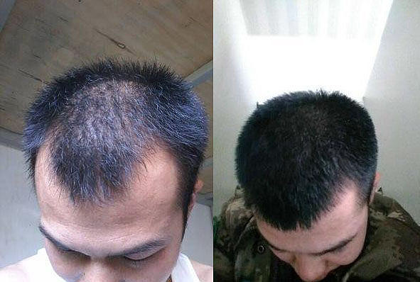 男生脫發(fā)嚴重怎么改善，男生脫發(fā)嚴重如何改善？有效方法大揭秘