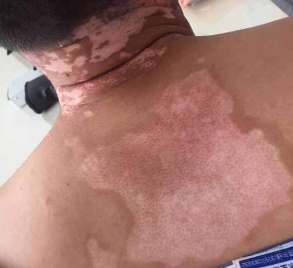 什么樣的白斑不用治——深入了解白斑的多種可能性，白斑的多種可能性解析，哪些白斑無需治療？