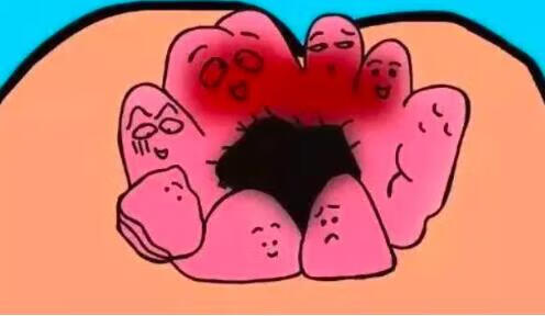 屁眼上面長了個(gè)小肉球，原因、診斷與治療方法，屁眼上長肉球，原因、診斷與治療方法全解析