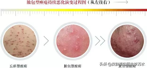 七種痘痘的種類圖解及其成因與防治策略，七種痘痘種類圖解，成因、防治策略全解析