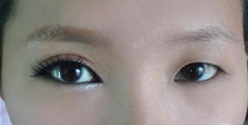 如何糾正眼皮一單一雙，專業(yè)指南與實用建議，眼皮一單一雙如何糾正？專業(yè)指南與實用建議全解析