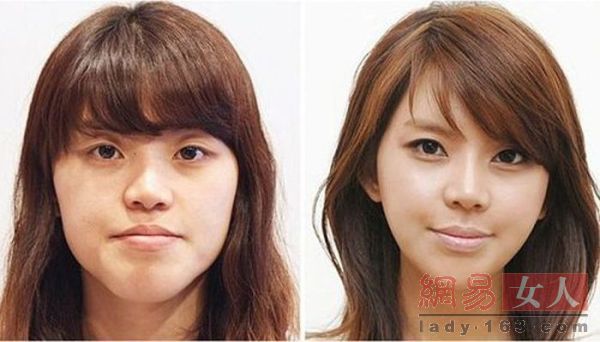 整容前后對照圖片大全，探索美麗轉(zhuǎn)變的藝術(shù)，整容前后對照圖片大全，美麗轉(zhuǎn)變的藝術(shù)探索