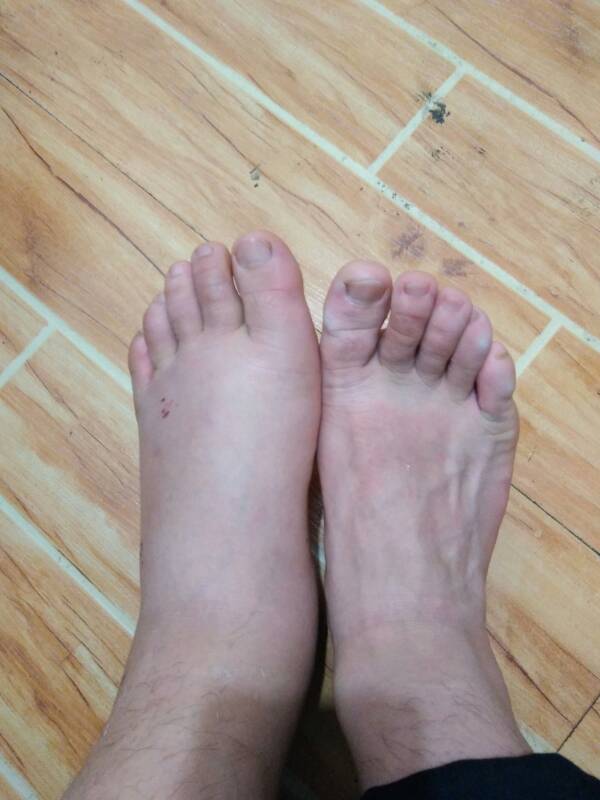 腳崴了出現(xiàn)腫脹如何快速消腫？，腳崴后腫脹如何迅速消腫？的解決方法探討