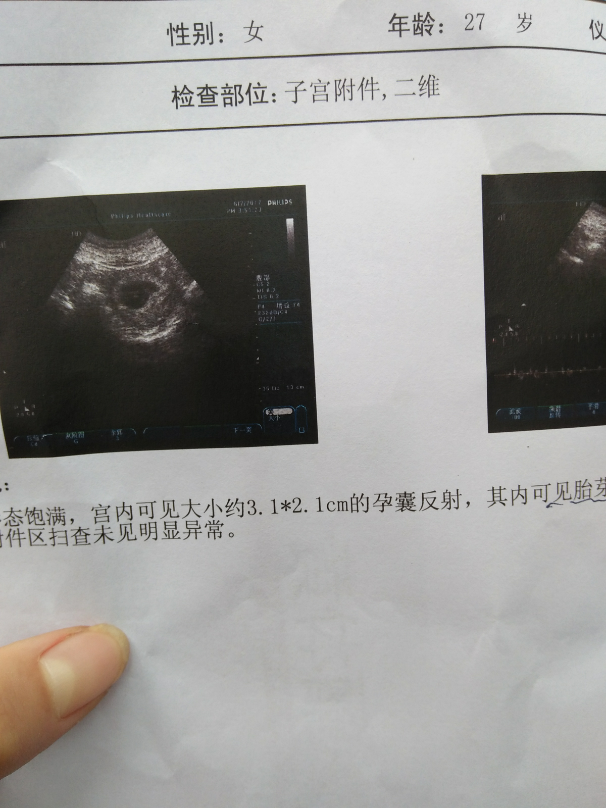 關于已生男孩孕囊圖片的探討，已生男孩的孕囊圖片深度探討
