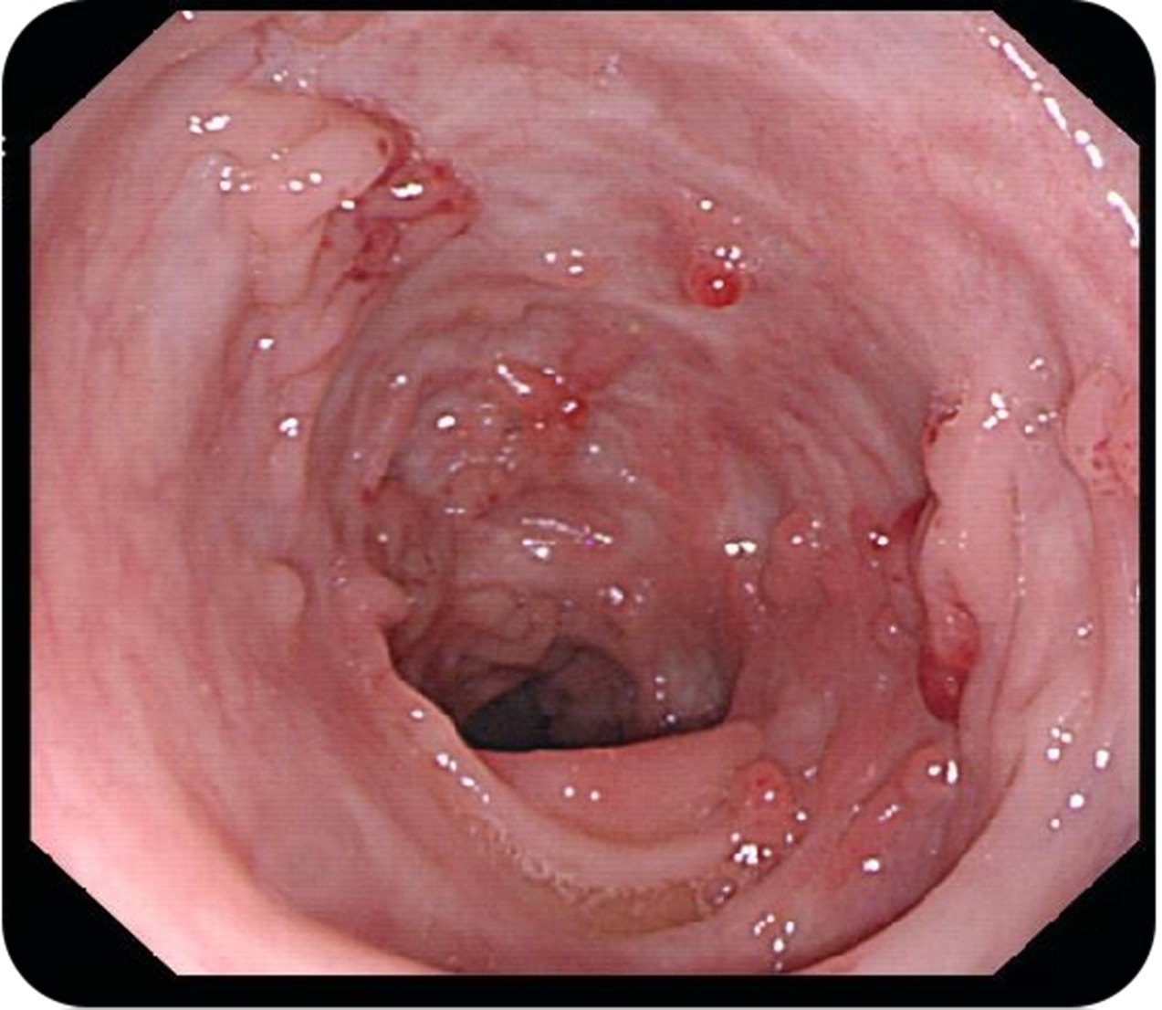 克羅恩病最常見的癥狀是什么？一篇文章深度解析，深度解析，克羅恩病最常見癥狀解析